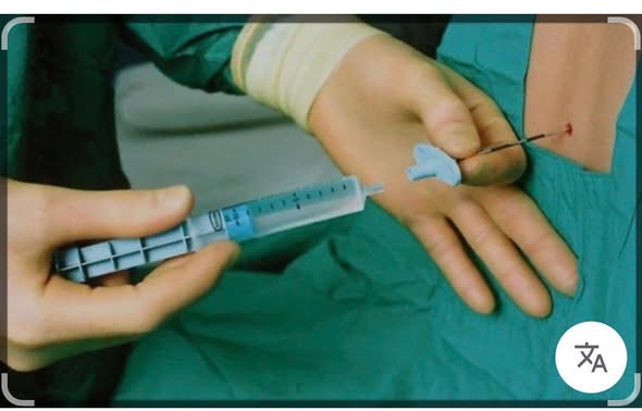 Giảm đau ngoài màng cứng khi sinh là ❓