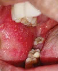 Sởi và những điểm cần nhớ