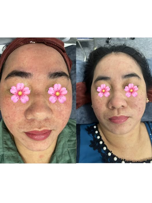 🌸 Dành cho những hành trình kiên trì - Vì làn da khỏe, không corticoid