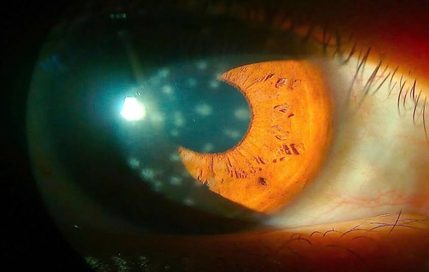 BIẾN CHỨNG VIÊM GIÁC MẠC CHẤM NÔNG SAU ĐAU MẮT ĐỎ