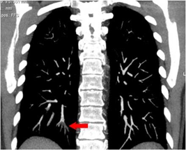 Huyết khối nhánh ĐM thùy dưới phổi P