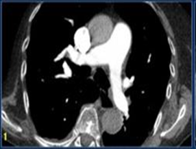 Động mạch phổi sau khi tiêm thuốc