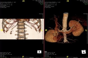 Dựng hình 3D hệ xương và thận