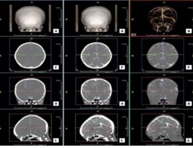 Chụp sọ não có thuốc cản quang