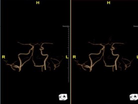 Chụp mạch máu não