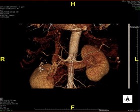 Dựng hình 3D mạch máu ổ bụng