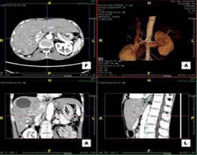 Chụp hệ tiết niệu